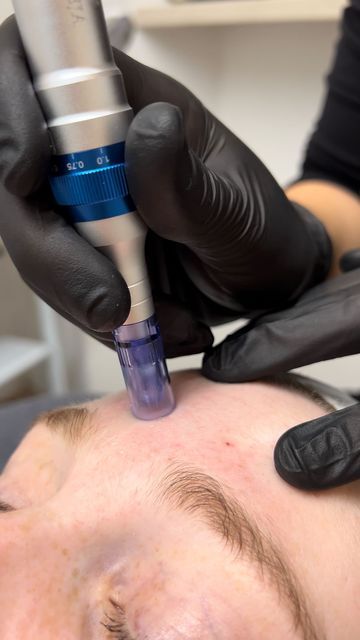 Microneedling 